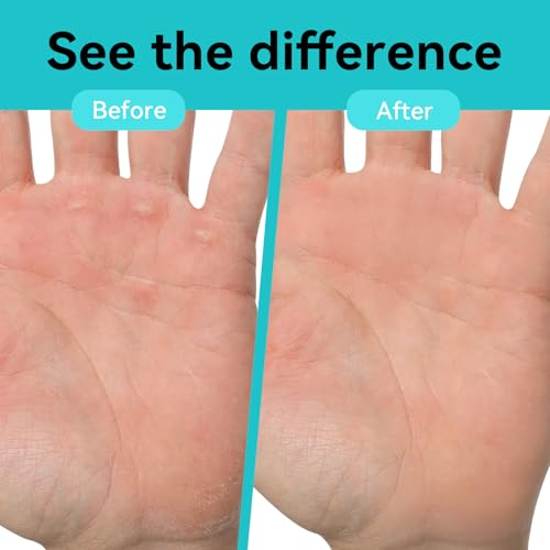 Double Sided Hand&Finger File-Flappers, Rips, Cracks-Strong Smooth Hands - Great for Gym, Rock Climbers
