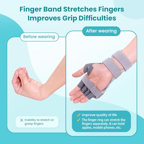 Radial Nerve Palsy Splint Brace for Wrist drop, 5 Fingers Extension, Stroke Patient Recovery, Finger Limp, Crutch Palsy, MCP Arthroplasty, for both Left and Right Hand - Gray - color: Gray