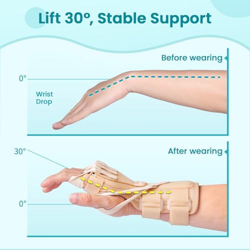 Radial Nerve Palsy Splint Brace for Wrist drop, 5 Fingers Extension, Stroke Patient Recovery, Finger Limp, Crutch Palsy, MCP Arthroplasty, for both Left and Right Hand - Beige - color: Beige
