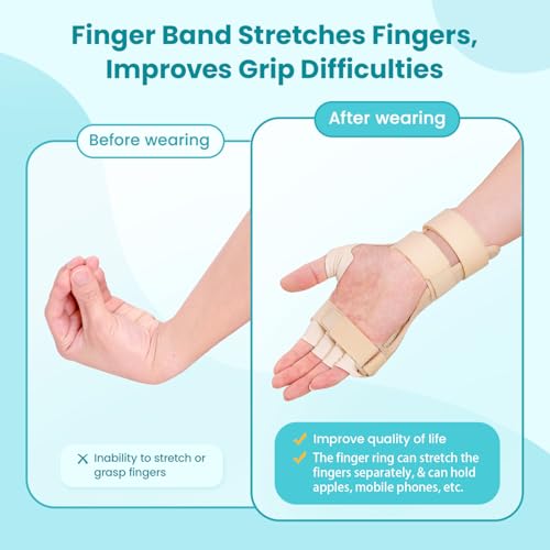 Radial Nerve Palsy Splint Brace for Wrist drop, 5 Fingers Extension, Stroke Patient Recovery, Finger Limp, Crutch Palsy, MCP Arthroplasty, for both Left and Right Hand - Beige - color: Beige