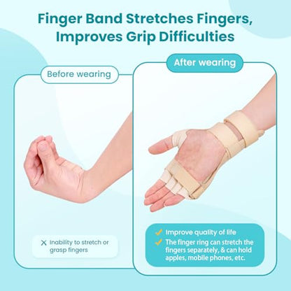 Radial Nerve Palsy Splint Brace for Wrist drop, 5 Fingers Extension, Stroke Patient Recovery, Finger Limp, Crutch Palsy, MCP Arthroplasty, for both Left and Right Hand - Beige - color: Beige