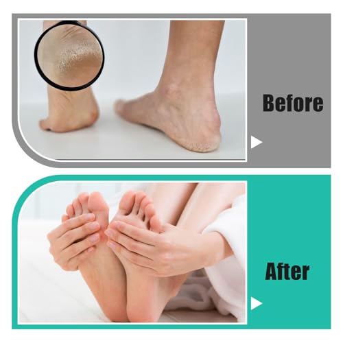 Professional Foot Rasp Callus Remover Set - 2 Stainless Steel Pedicure Files with 12 Replacement Blades (Coarse & Fine Grit) for Dead Skin Removal, Home Salon Foot Care