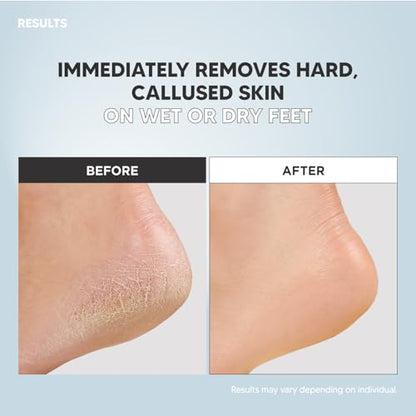 S-Line Emery Foot File & Foot Spray Set, Colossal Double-Sided Pedicure Tool, Effective for Cracked Heel, Ergonomic Design for Easy Grip, Dead Skin Remover, Callus Rasp, Scrubber - color: Set