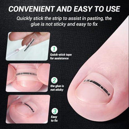Titanium Alloy Ingrown Toenail Treatment, Nail Tools, and Ingrown Toenail Removal Kit Specially Designed for Curved Nail Repair and Ingrown Toenail Corrector (0.67/0.79in) - size: 0.67/0.79in