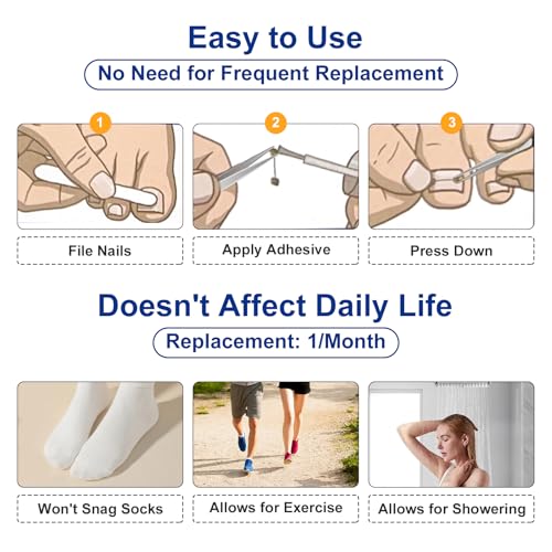 Nitinol Ingrown Toenail Corrector,at Home Ingrown Toenail Treatment,Curved Toenail Straightener,Ingrown Toe Nail Relief，Ingrown Toenail Removal Kit (1/2 In,11/16 In) - size: 1/2 In,11/16 In
