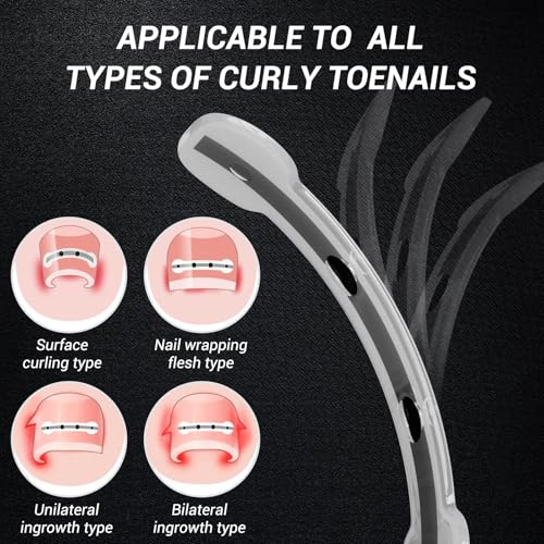 Titanium Alloy Ingrown Toenail Treatment, Nail Tools, and Ingrown Toenail Removal Kit Specially Designed for Curved Nail Repair and Ingrown Toenail Corrector (0.59/0.67in) - size: 0.59/0.67in