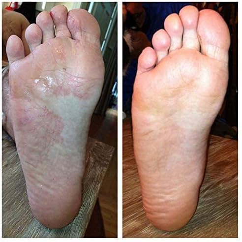 Toenail Fungus Treatment Extra Strength - Advanced Foot & Shoe Deodorizer Spray - XL - Athletes Foot Shoe Spray for Fungal Treatment - 5.07 Fl oz - size: 5.07 Fl Oz (Pack of 1)