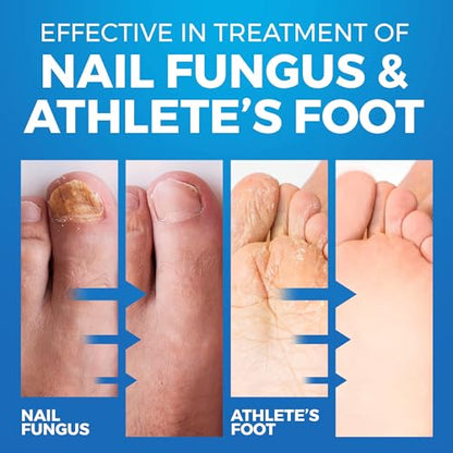 Toenail Fungus Treatment Extra Strength - Advanced Foot & Shoe Deodorizer Spray - XL - Athletes Foot Shoe Spray for Fungal Treatment - 5.07 Fl oz - size: 5.07 Fl Oz (Pack of 1)